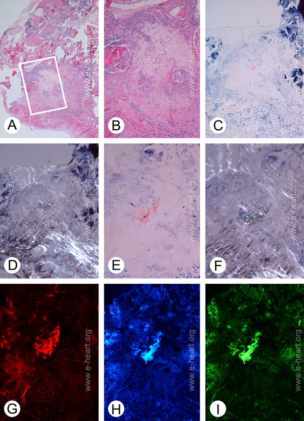 Amyloid in calcified valve